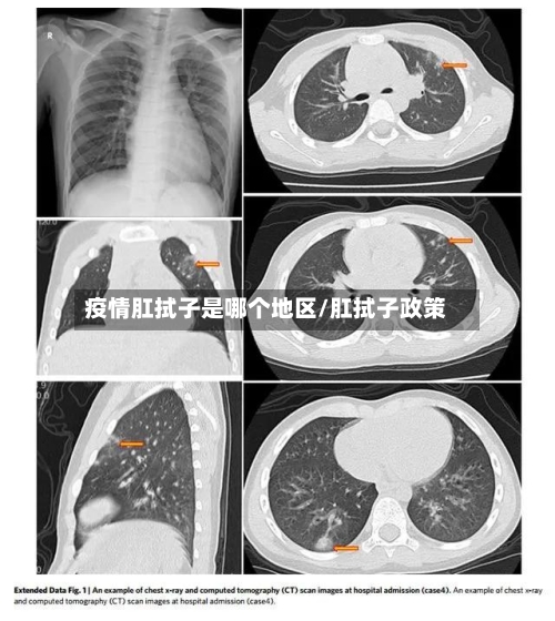 疫情肛拭子是哪个地区/肛拭子政策-第3张图片